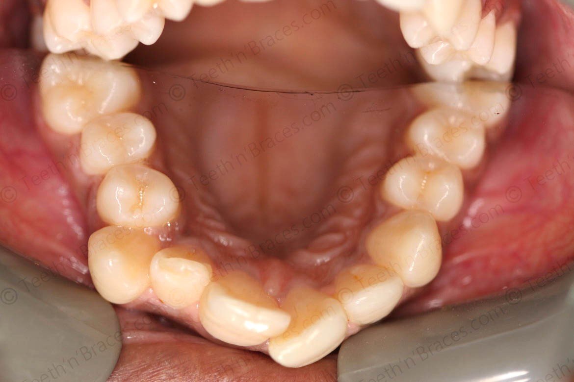 AO-PRE-C15