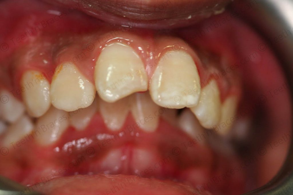 Treated Cases-PRE-C11