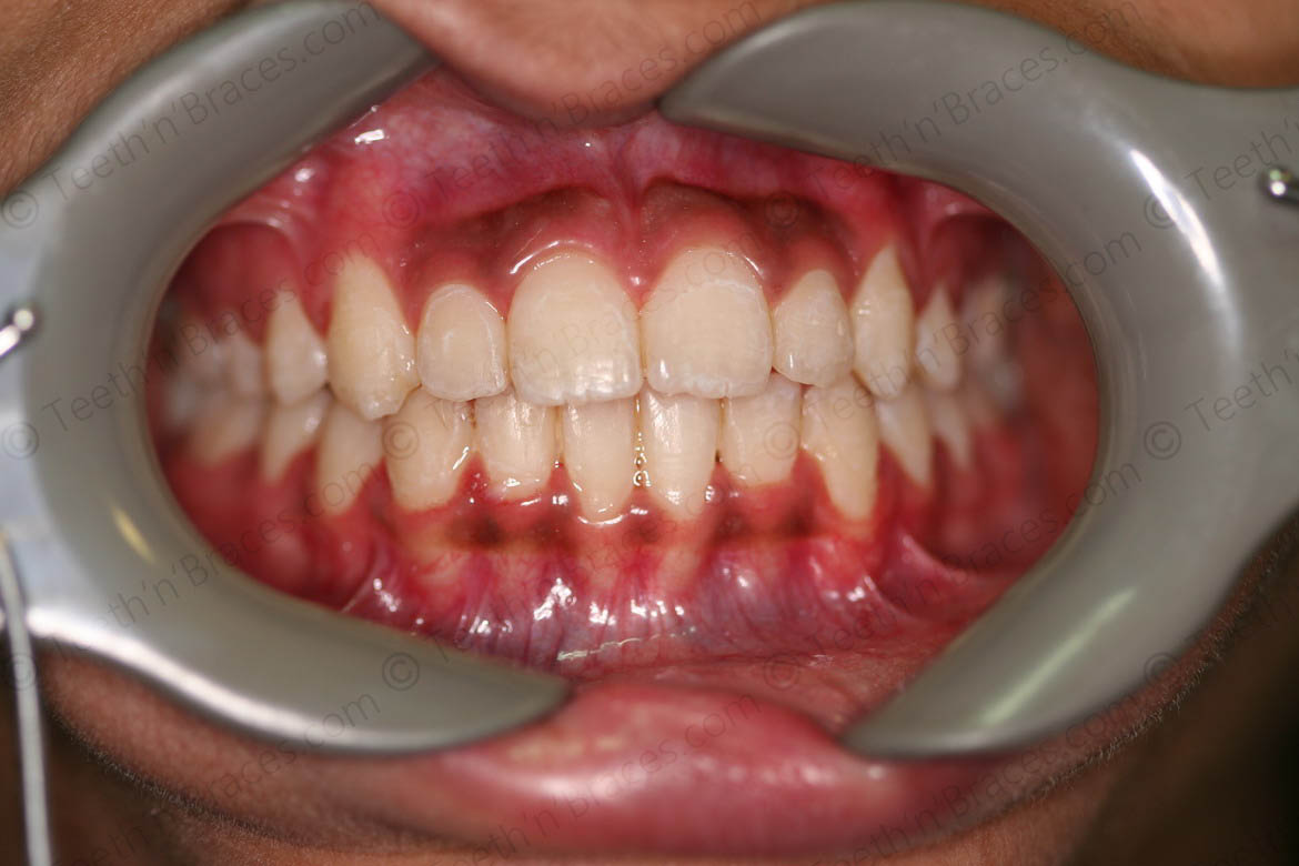 Case 19: Canines placed high and out | Teeth N Braces