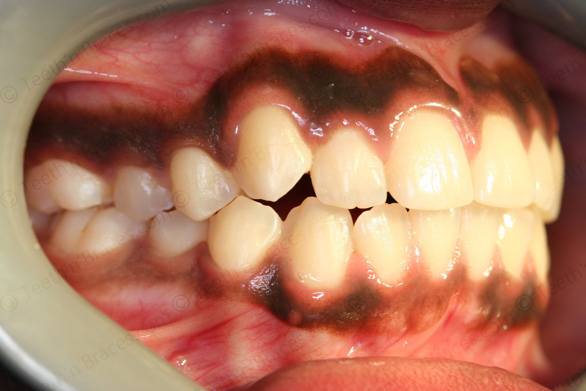 Orthodontics | Teeth N Braces