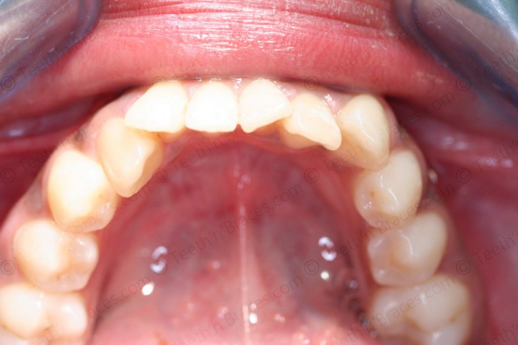 Treated Cases-PRE-C9