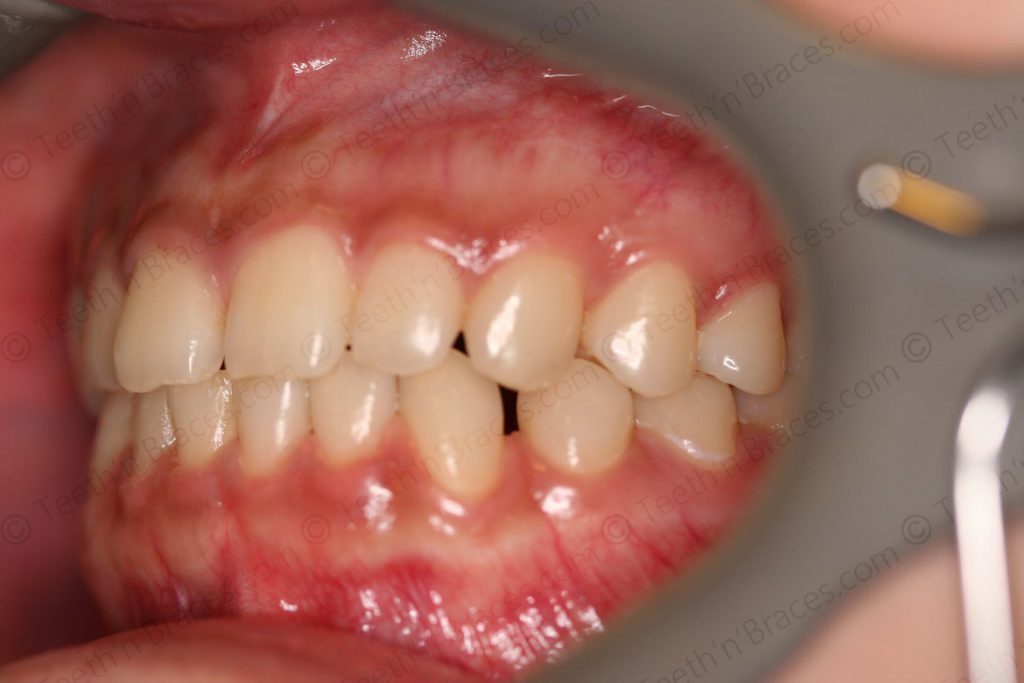 Treated Cases-PRE-C32