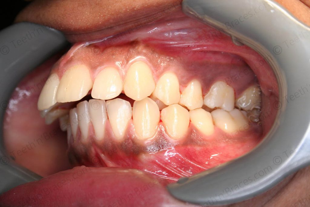 Treated Cases-PRE-C17