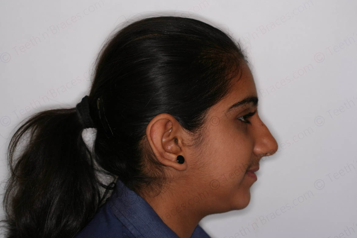 Case 19: Canines placed high and out | Teeth N Braces