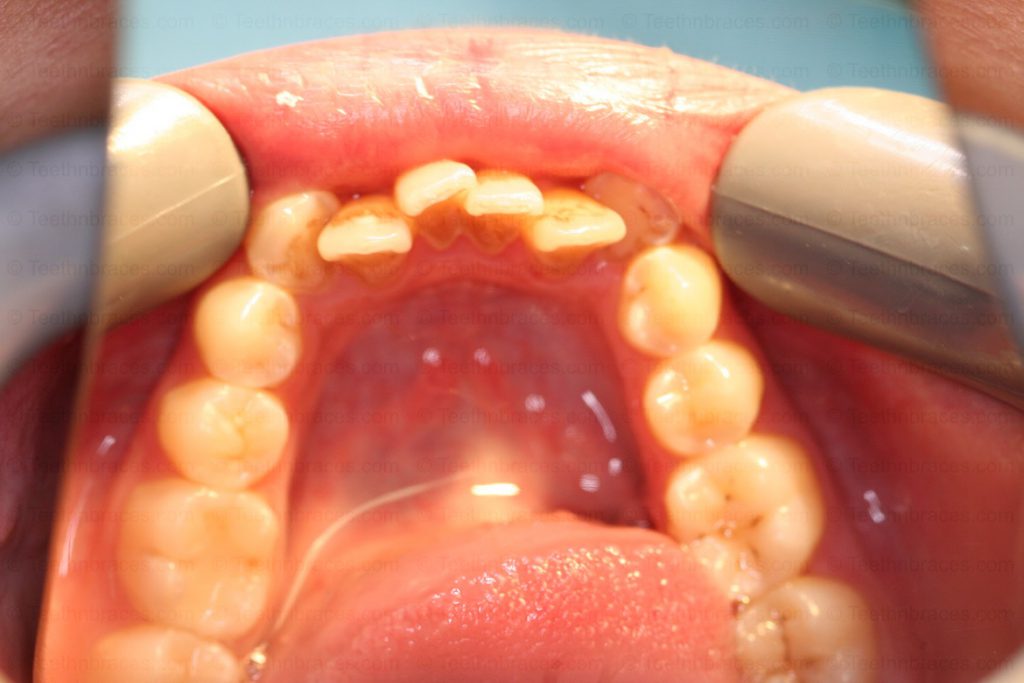 Treated Cases-PRE-C40